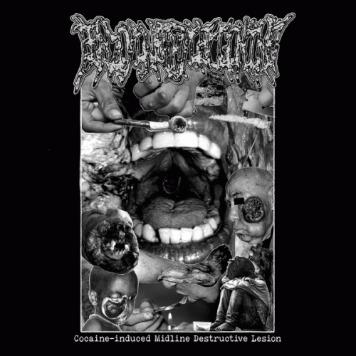 Cocaine-induced Midline Destructive Lesion